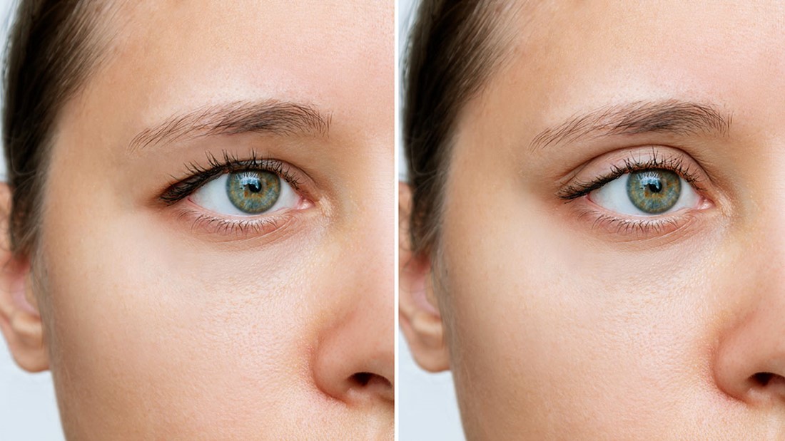 Blepharoplasty And Dermatochalasis